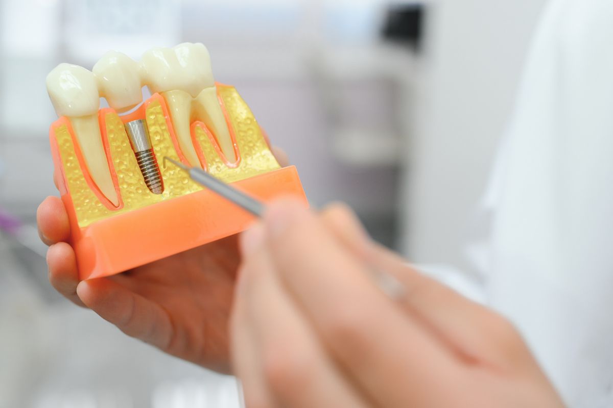 dental implant aftercare guide