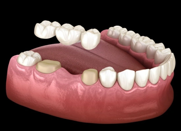 dental crowns and bridges in brooklyn heights