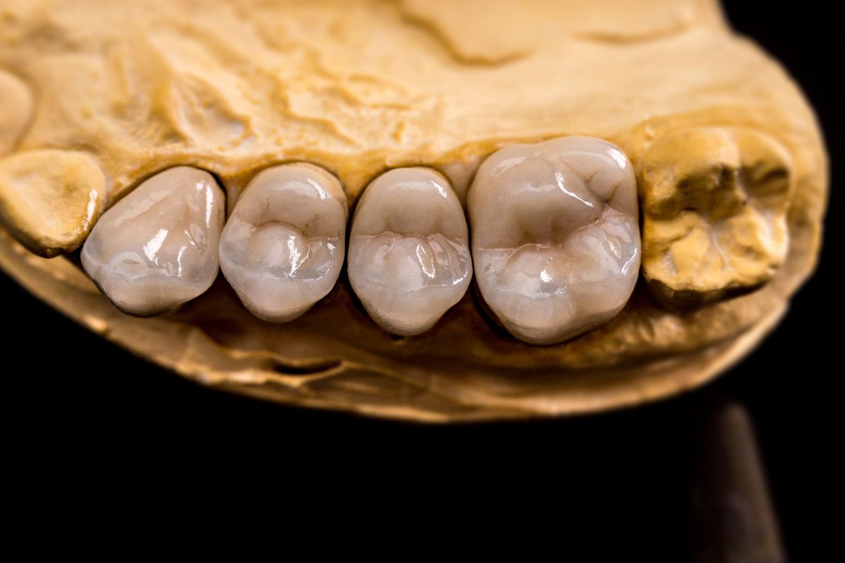 dental crown and bridge in brooklyn