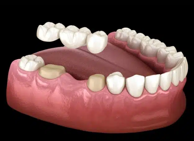 dental crowns bridges in franklin ave, brooklyn