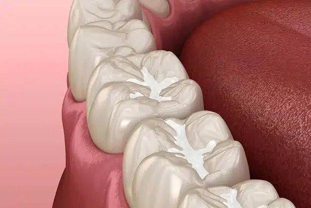 dental sealants in brooklyn heights